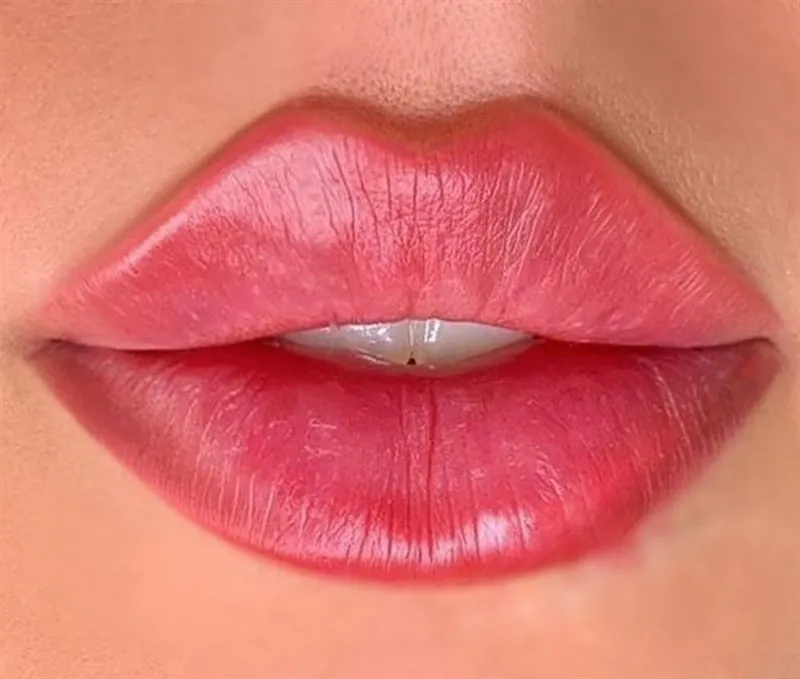 Embracing Elegance: The Artistry of Russian Lip Filler Techniques
